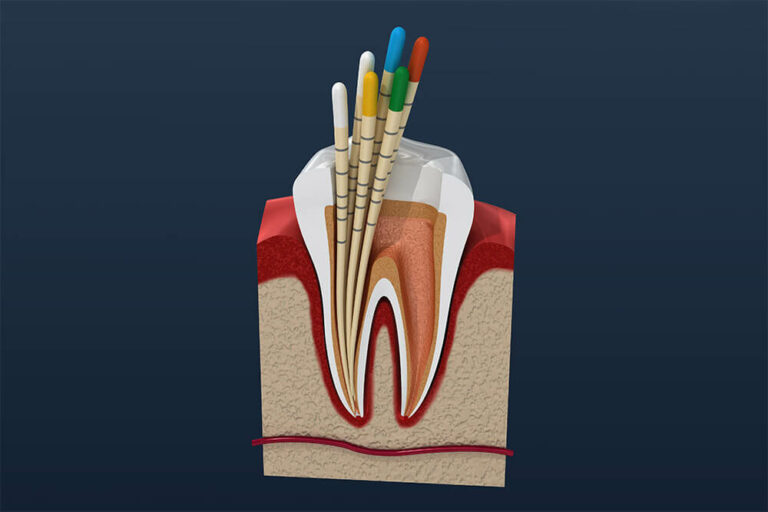 illustration of a tooth that needs a root canal