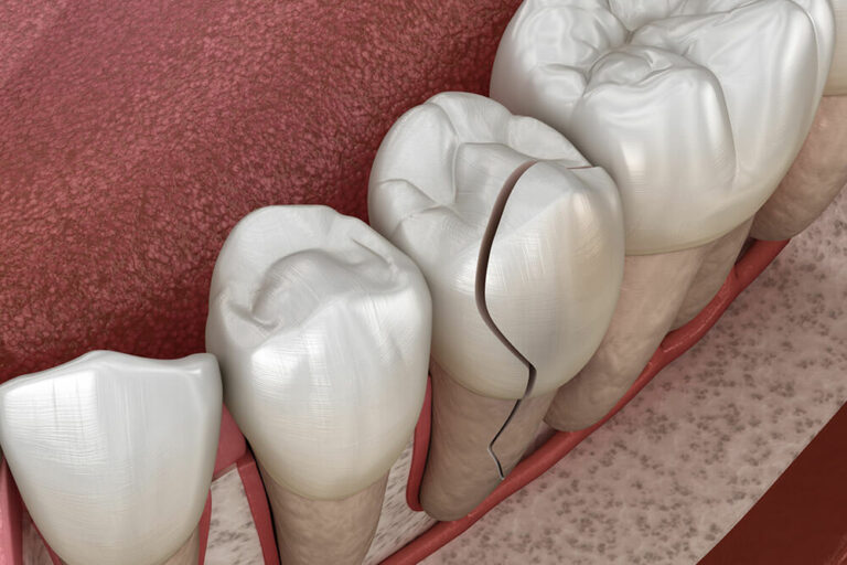 illustration of damaged tooth enamel