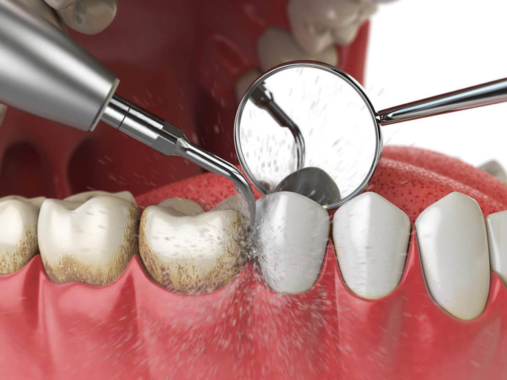 illustration of plaque being removed from teeth during a professional teeth cleaning