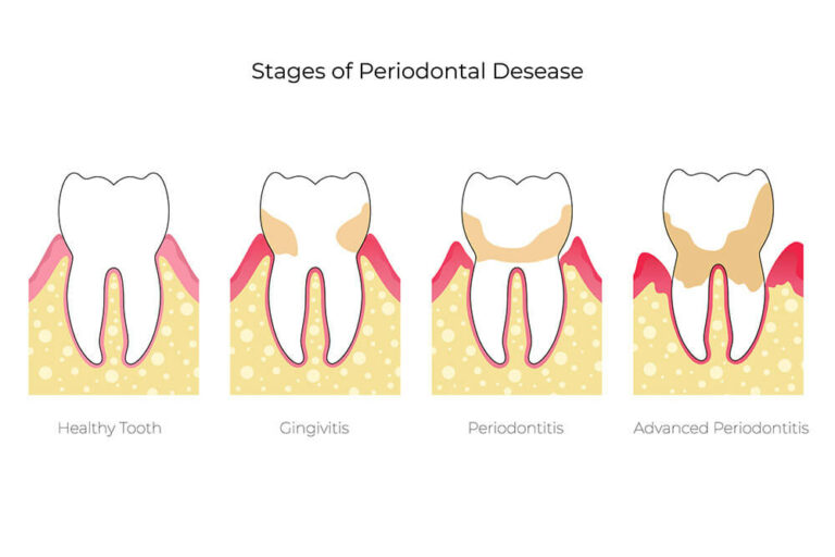 illustration of the different stages of periodontal disease