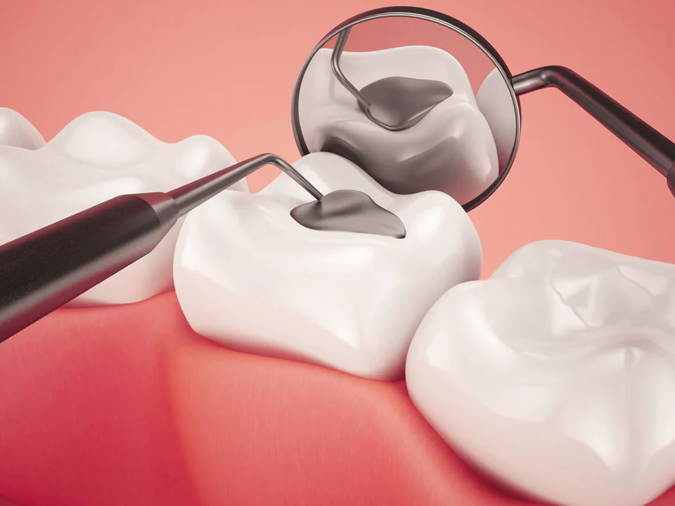 Tooth fillings & sealants in Finger Lakes, New York at Finger Lakes Dental Care